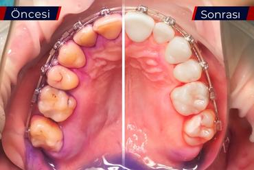 Diş Taşı Temizliği Sonrası