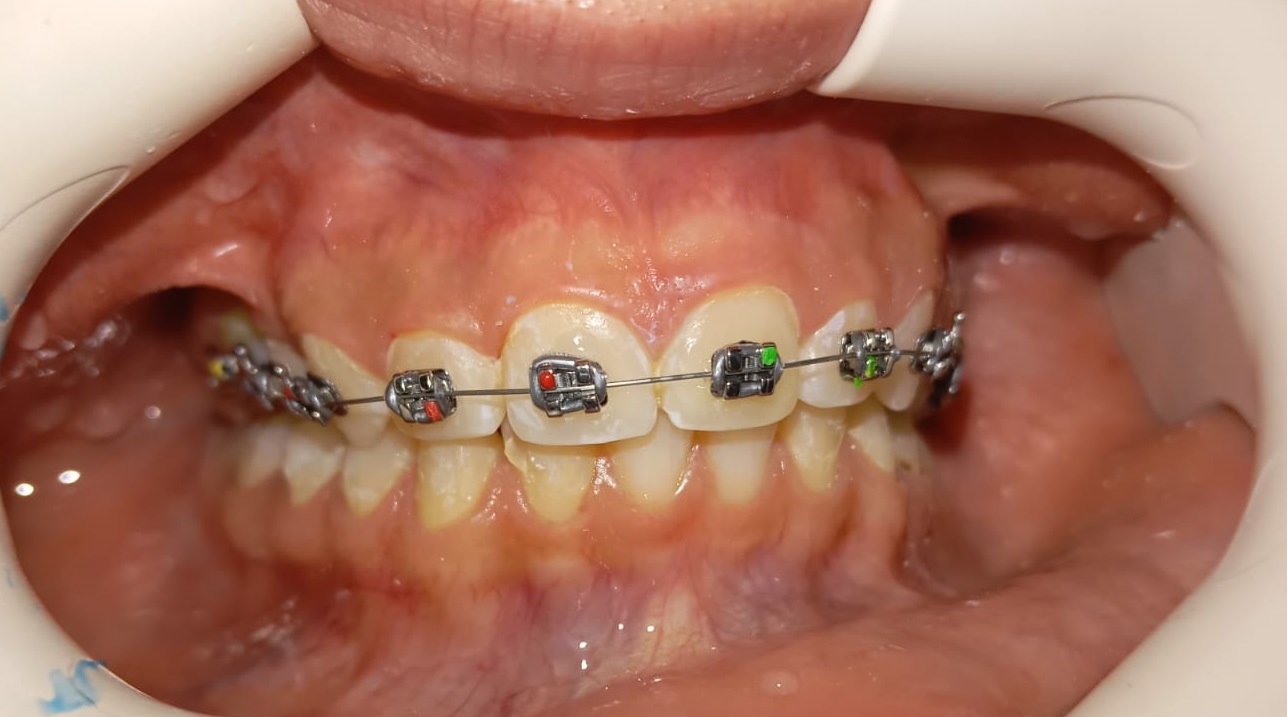 Diş Teli Fiyatları