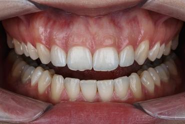 Gingival Nedir?