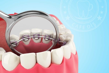 Görünmez (Lingual) Diş Teli