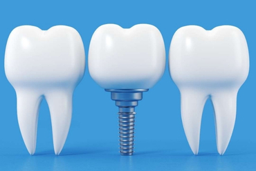 İmplant Sonrası Beslenme