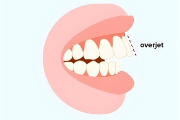 Overjet Nedir?